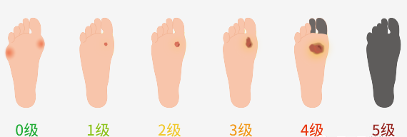 糖尿病足分级.png