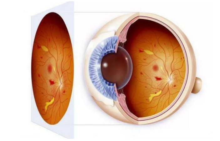 糖尿病视网膜病变.png