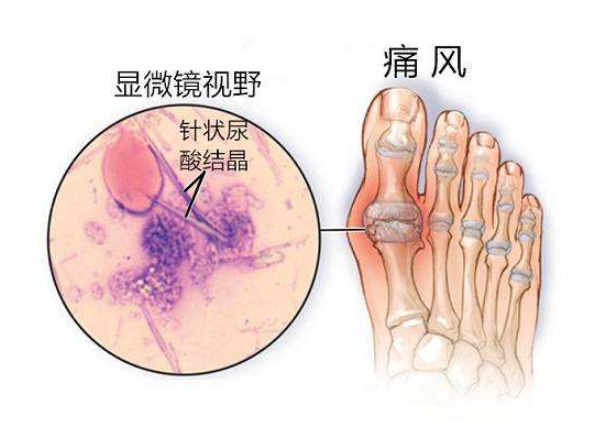 痛风和高尿酸是怎么回事，沙棘对痛风病人的食效果