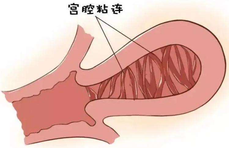 宫腔粘连.png