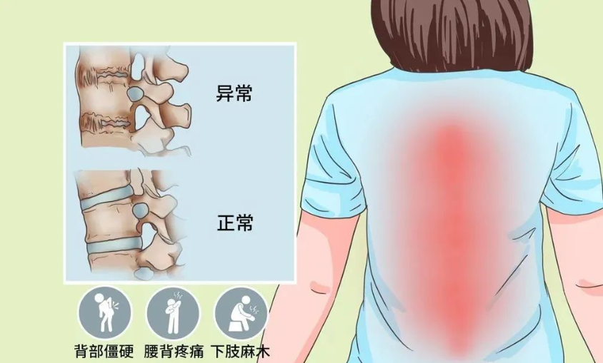间充质干细胞对强直性脊柱炎效果好吗，干细胞与强直