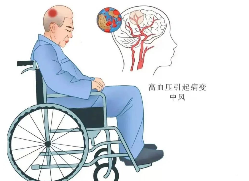 干细胞什么时候能应用干预脑出血后遗症？