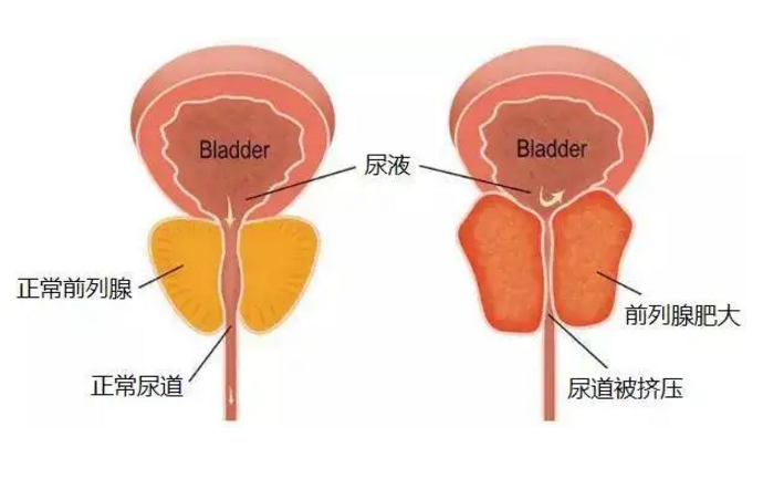 4个办法缓解前列腺增生症状，前列腺增生干预方法