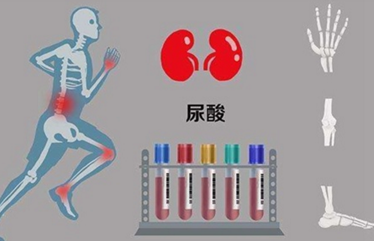尿酸不只和吃进去的嘌呤有关，吃糖竟然也会引起高尿酸