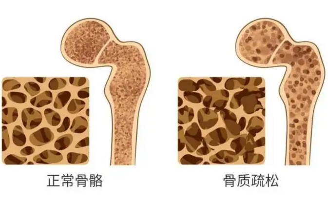小分子活性肽增加骨密度的原理，肽真的可以增加骨密度吗