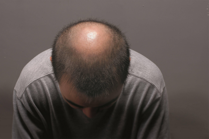 干细胞疗法与治疗斑秃，干细胞与脱发