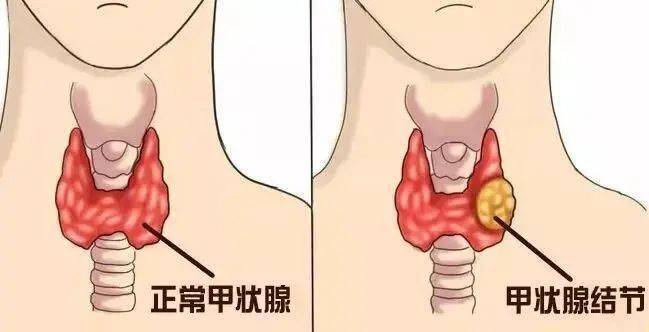甲状腺结节能治愈吗,结节囊肿吃内消瘰疬丸有用吗?