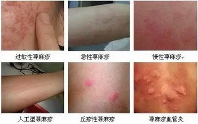荨麻疹的症状和原因,荨麻疹怎么治疗能除根?