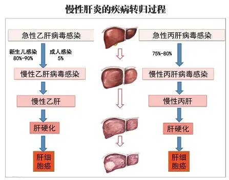 慢性肝炎是怎么得的,慢性肝炎吃什么药有效？