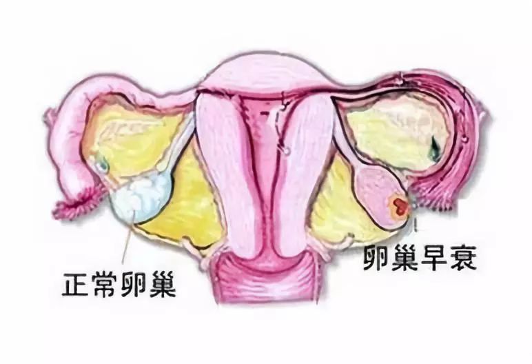 卵巢早衰怎么引起的,卵巢早衰有什么后果？