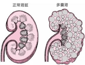 肾囊肿的症状表现,肾囊肿怎么控制不长大?