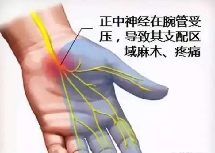 经常手麻吃什么药能缓解,,手麻有什么办法解决?