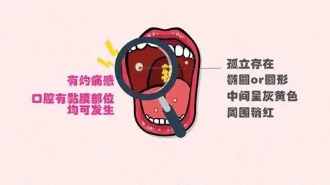 口腔溃疡怎么预防,口腔溃疡怎么办?