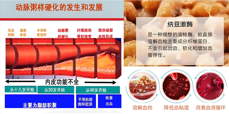 ,纳豆激酶抗动脉粥样硬化的作用机制,纳豆激酶对动脉硬化有效吗？