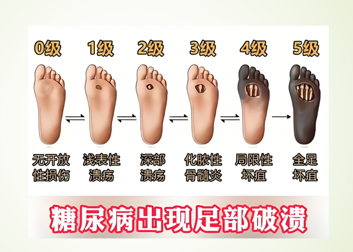 糖尿病足的发病机制,活性多糖促进糖尿病足的愈合作用.