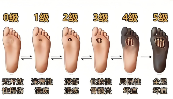 岩藻多糖与促进糖尿病足的愈合